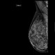 Mammography, dense type, normal finding: MMG - Mammography